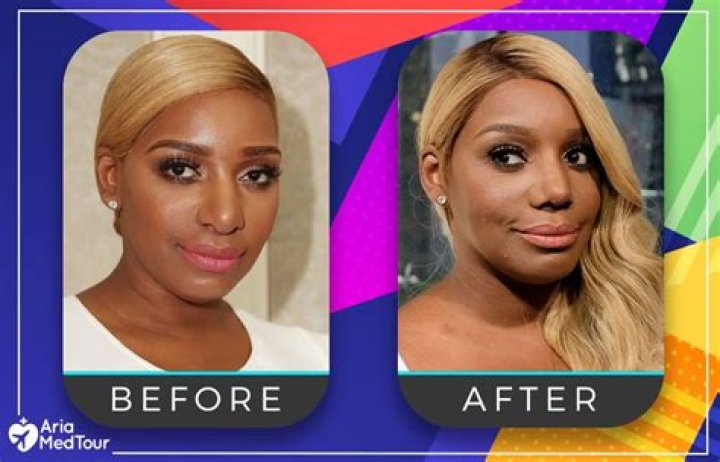 Mai Pham Nose Job | Before And After Photos